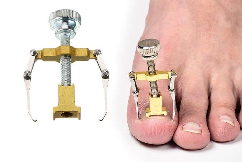 ingrown toenail correction tool