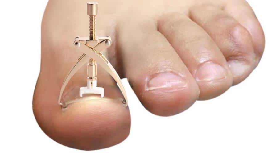 ingrown toenail correction tool