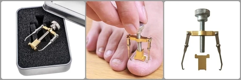 Ingrown Toenail Correction Tool: Perform The Delicate Procedure On Yourself At Home 43 ingrown toenail correction tool
