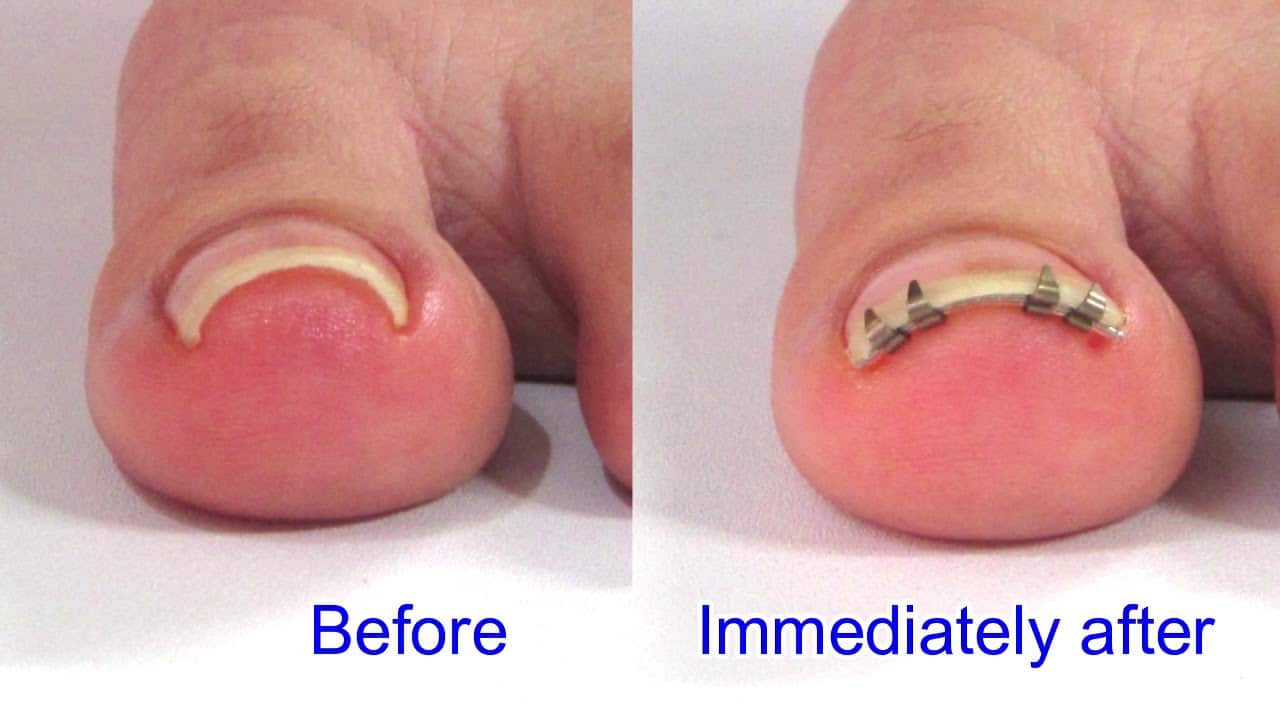 ingrown toenail correction tool